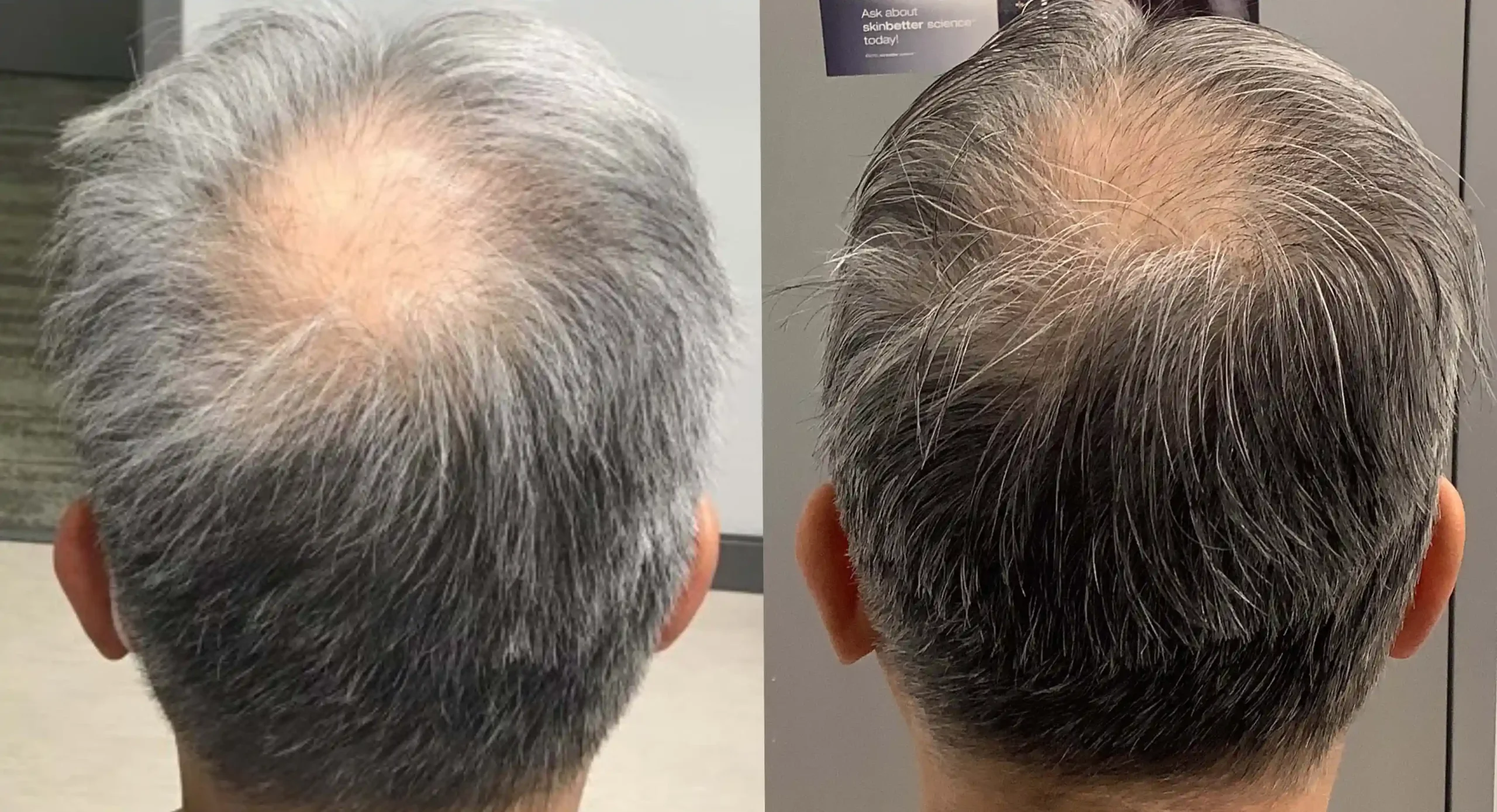 Alma TED hair restoration